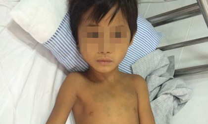 Bé trai nguy kịch vì nhiễm xoắn khuẩn vàng da từ động vật 