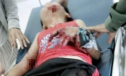 Lựu đạn đồ chơi bất ngờ phát nổ, 2 trẻ nhập viện cấp cứu