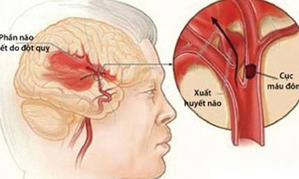 Đột quỵ - bệnh nguy hiểm chết người dễ mắc vào mùa đông