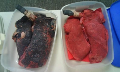 Bác sĩ sốc khi nhìn phổi đen như bồ hóng