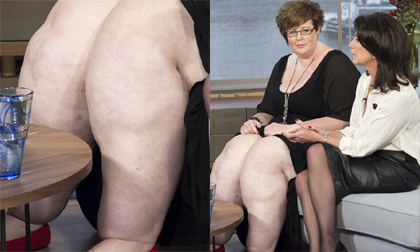 Người phụ nữ có đôi 'chân voi' nặng 64kg