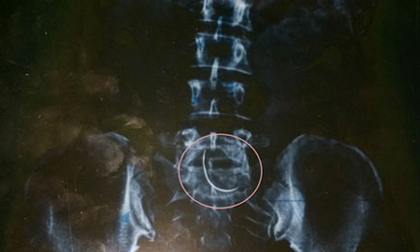 Mổ đẻ, bác sĩ 'quên' kim trong bụng bệnh nhân 9 năm