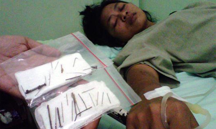 Bệnh nhân mọc 2.000 cây đinh từ trong cơ thể, bác sĩ phải “cầu cứu” phép thuật