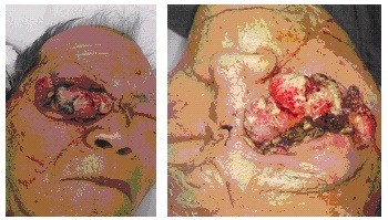 Bác sĩ kinh hãi phát hiện ổ giòi trong mắt bệnh nhân