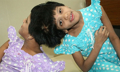 Cặp song sinh dính liền thân cùng chia sẻ một trái tim