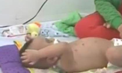 Bé trai 2 tuổi bị bà ngoại đánh đã ổn định sức khỏe