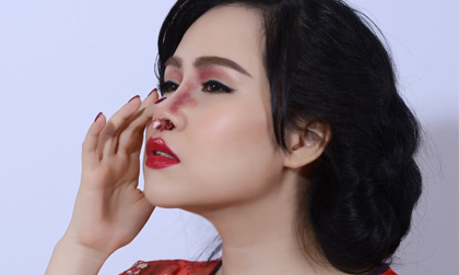 Trương Phương 'lộ' ảnh đau đớn khi 'phẫu thuật thẩm mỹ'