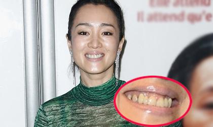 Củng Lợi mất điểm hoàn toàn với hàm răng xỉn màu