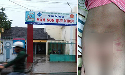 Bé 3 tuổi bị cô giáo đánh bầm dập vì đi tiểu nhiều
