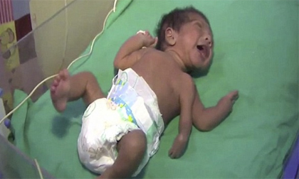 Bé sơ sinh có 3 cánh tay, tinh hoàn nằm trong dạ dày