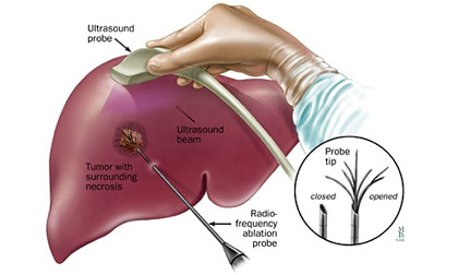 Việt Nam điều trị thành công ung thư gan bằng hạt vi cầu phóng xạ