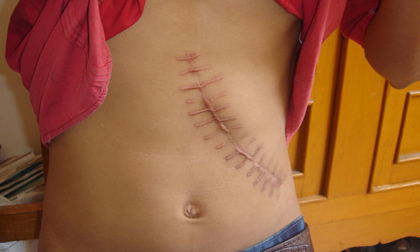 Chợ đen mua bán thận ở Việt Nam