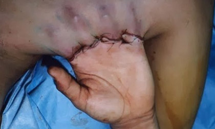 Chùm ảnh những ca phẫu thuật cấy ghép siêu kinh điển của y học