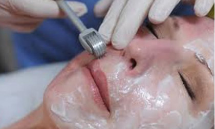 Da căng bóng, hết sẹo với phương pháp lăn kim tế bào gốc