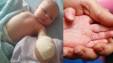 Cậu bé bình phục kỳ diệu sau khi bị cáo cắn lìa ngón tay