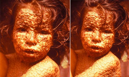 Biến đổi khí hậu có nguy cơ  bùng phát dịch đậu mùa