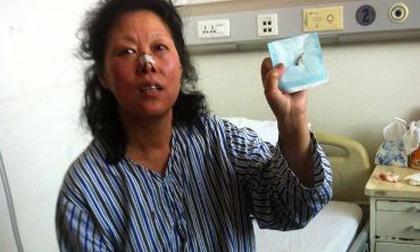 Bị đạn găm trong sống mũi suốt 48 năm