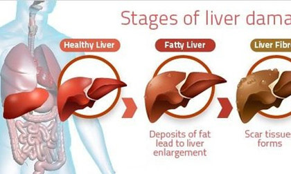 Phòng bệnh men gan cao - căn bệnh diễn biến âm thầm