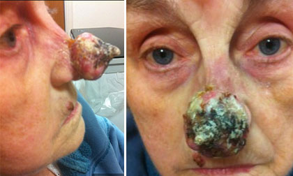 Cụ bà bị cắt mũi vì mọc khối u ác tính