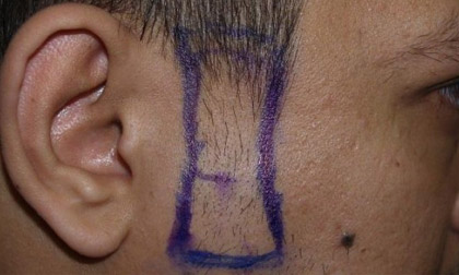 Mốt cấy râu quai nón để quyến rũ hơn