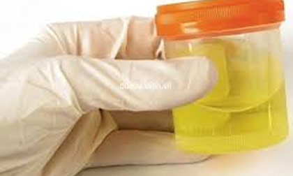 Khám bệnh qua màu sắc nước tiểu