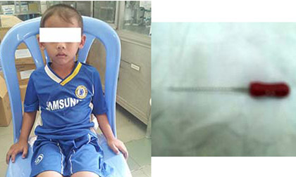 Bé 4 tuổi nuốt phải cây kim trong lúc lấy tủy răng