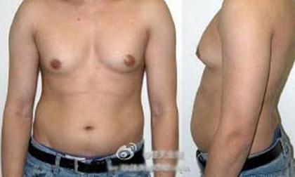 Chàng trai có ngực như phụ nữ vì ăn nhiều sữa ong chúa