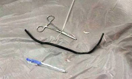 Nuốt dây điện dài 40cm vào bụng rồi quên bẵng 2 năm