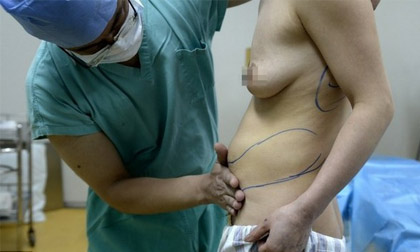 Bầu ngực nhân tạo di chuyển xuống bụng và lưng sau ca phẫu thuật hỏng