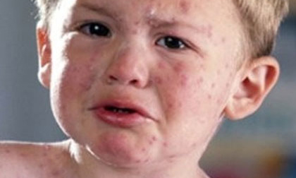 Cách nhận biết sớm triệu chứng và điều trị bệnh sởi