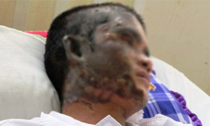 Đang ngủ, nam thanh niên bị tạt axit vào mặt
