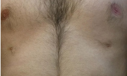 Người đàn ông mọc tới 6 núm vú trên cơ thể
