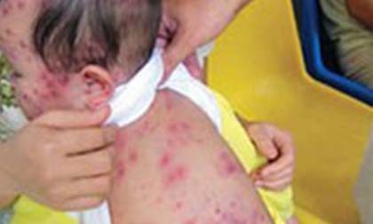 Không có chuyện Bộ Y tế giấu thông tin về bệnh sởi