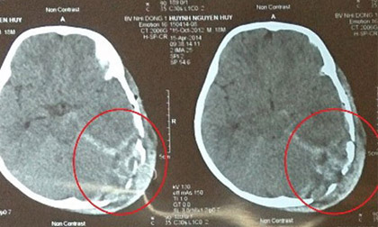 Bị ti vi đè vỡ sọ, bé 2 tuổi tử vong
