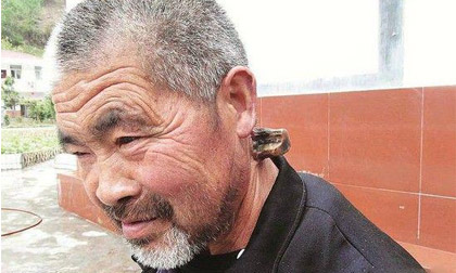 Kỳ lạ người đàn ông mọc sừng sau gáy