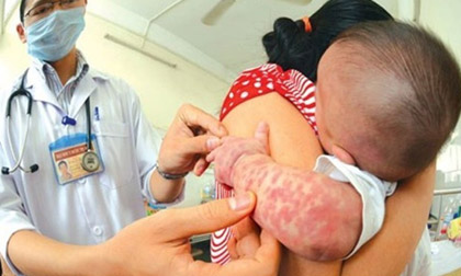 Bệnh sởi: Xuất hiện diễn biến lạ