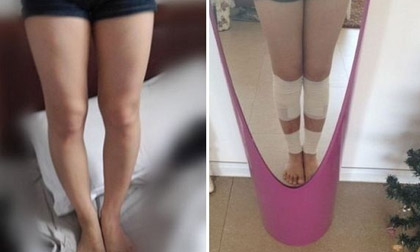 Kéo dài chân - thú làm đẹp kinh hoàng 