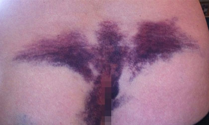 Chú rể hoảng hốt trước vết thâm tím hình... thiên thần của mình