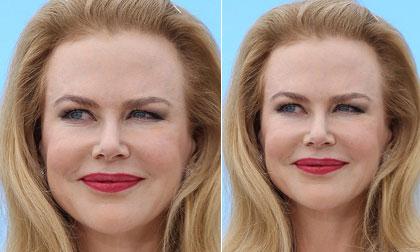 'Thiên nga Úc' Nicole Kidman lộ mặt biến dạng sưng phồng vì thẩm mỹ