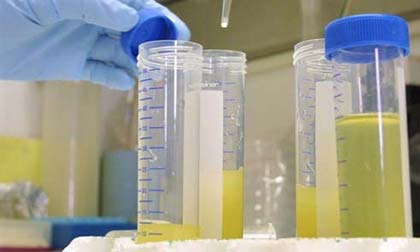 Nhận biết bệnh tật qua nước tiểu 