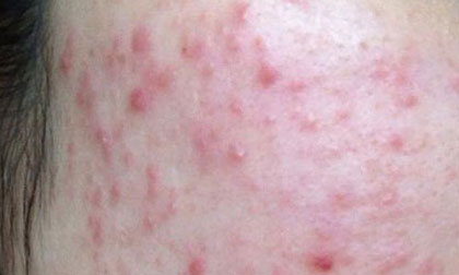 Tàn phá dung nhan vì ham mỹ phẩm "xịn" giá bèo