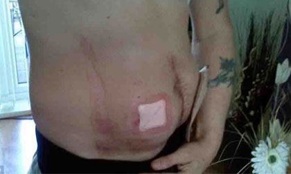 Hãi hùng dạ dày bệnh nhân bốc cháy trên bàn mổ