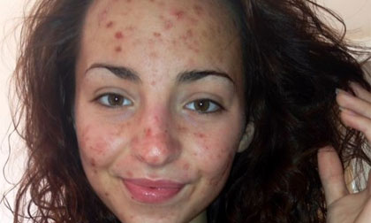 Mắc bệnh lạ, cô gái trẻ nghiện cào mặt 6 tiếng mỗi ngày