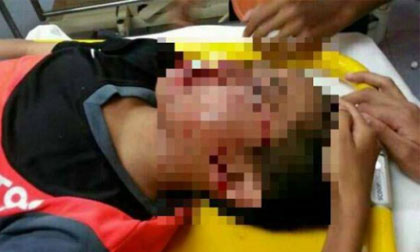 Cãi nhau, học sinh lớp 2 cắt đứt tai bạn