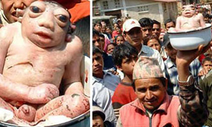 Em bé sinh ra giống... ếch