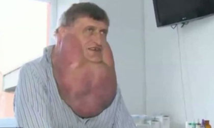 Kinh hoàng khối u nặng gần 6kg "đeo" trên mặt hơn một thập kỷ