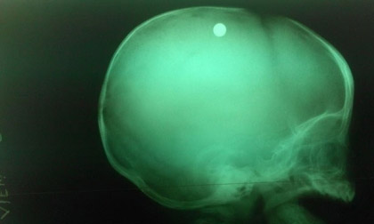 Chị gái nghịch súng, bé trai 6 tháng tuổi bị bắn vào đầu