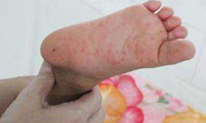 Biện pháp cần thiết để phòng bệnh tay chân miệng