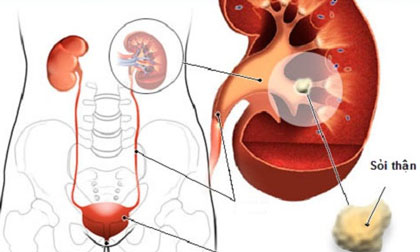 Tất cả những điều bạn cần biết về bệnh sỏi thận