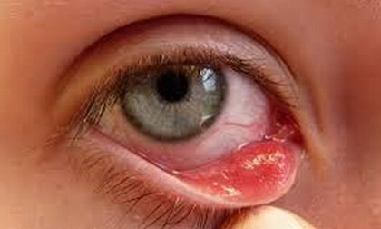 Mẹo đơn giản ngừa đau mắt đỏ mùa hè